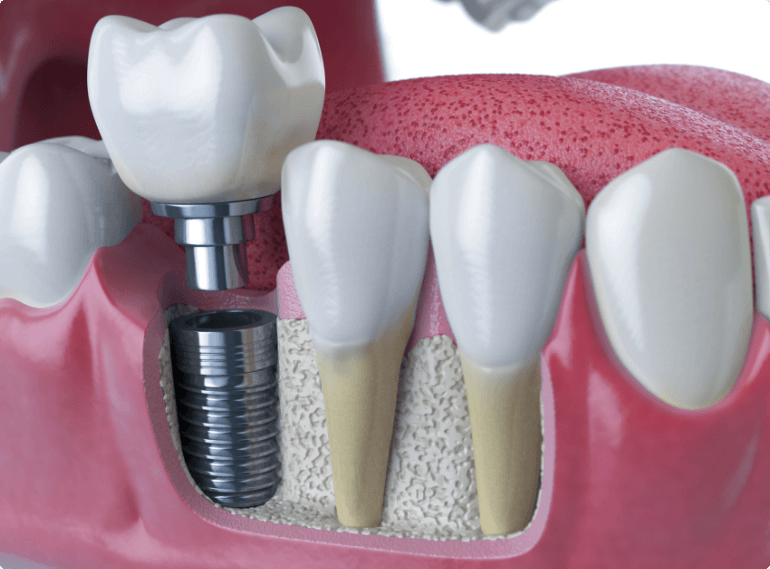 teeth-whitening-procedure